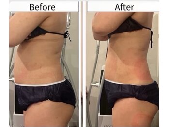 ルキア(LUKIA)/痩身【脂肪冷却】症例１　おなか