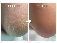 巻き爪補正店 金山店/角質ケア（施術前と施術後）