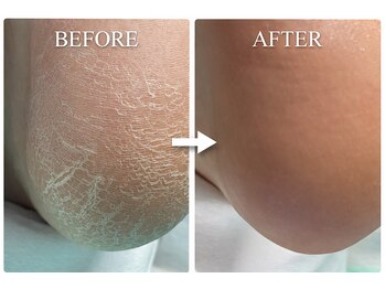 巻き爪補正店 金山店/角質ケア（施術前と施術後）