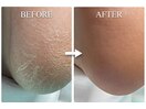 角質ケア(施術前と施術後)
