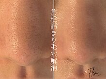 フレキシ 表参道(Flexi)/毛穴詰まりにハーブピーリング
