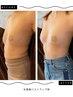 【同時施術でお得】＼クーパー靭帯復活／光豊胸バストアップ　オプション