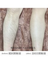 ランプ(LAMP)/～メンズ脚脱毛～