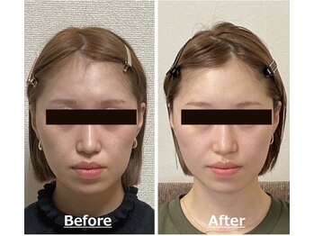 小顔22 ボルティ 赤坂支店(Bolty)/20代：施術5回