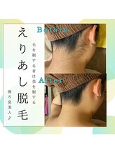 ソラ(SORA)/襟足脱毛