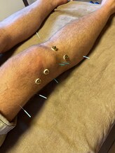 ライズ/お膝まわりへの施術