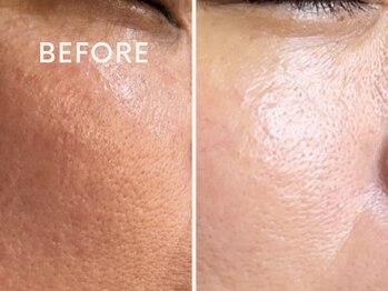 コハク(kohaku)/ララピール/肌質変化