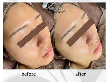 アン ビューティー(ann beauty)/施術1回【症例写真】20代女性