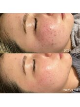 リリアス(RILLIAS)/ニキビケア