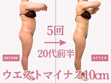 べモーレ 上本町 谷町九丁目(Bemolle)/20代痩身5回ビフォーアフター☆