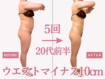 べモーレ 上本町 谷町九丁目(Bemolle)/20代痩身5回ビフォーアフター☆