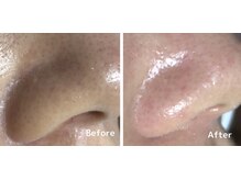 ココ 千里丘(Cocoh)/《毛穴洗浄》ハイドラピーリング