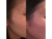 サロン ニコリー(Salon Nicolly)/シミケアbefore×after