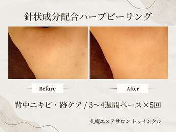 プライベートエステサロン トゥインクル/5回までは1ヶ月以内のケアが◎