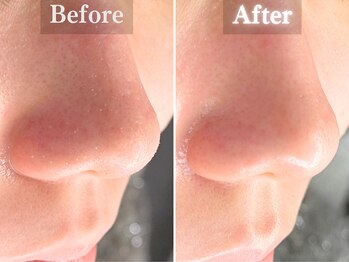 ボーンオム(Born Homme)/毛穴洗浄+美容液導入:20代男性