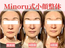 フレキシボディ(FlexiBody)/小顔施術ビフォーアフター #7