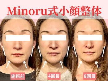 フレキシボディ(FlexiBody)/小顔施術ビフォーアフター #7