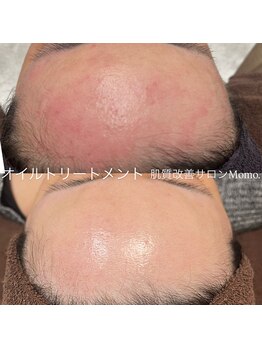 モモ(Momo.)/【敏感肌さんにも】オイルケア