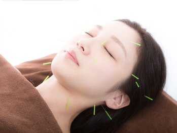 すぎた整骨院の写真/二重あご/もたついたフェイスライン/たるみでお悩みの方におすすめ☆美容鍼でキュッと引き締まった小顔に♪