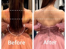 ブライダル前に脂肪冷却で背中美人♪