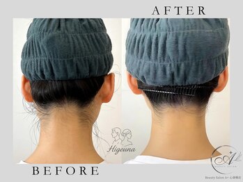 エープラス 心斎橋店(A+)/ひげうな脱毛