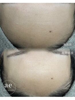 アエ(ae)/ダクトピール