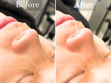 ボーンオム(Born Homme)/毛穴洗浄＋美容液導入：30代男性