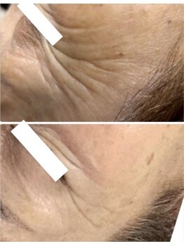 ライリー(Rairy)/ヒト幹ハーブピーリング