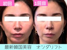 モテキ 表参道店(MoTeKi)の雰囲気（小顔リフト/ララピール/ハーブピーリング/小顔矯正）