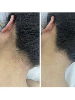 カルディエ(Cardie)/パーツ脱毛