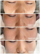 ピュア 川越店/光フェイシャル