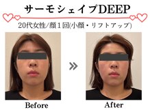 スパイア(SPIRE)/サーモシェイプDEEP★顔★痩身
