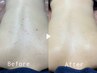 【夏までに背中美人計画★】REVIハーブピーリング5回コース♪