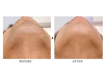 サロン ド スカイ(Salon de sky)/男性・ヒゲ