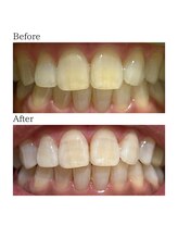ノーブル 上土店(Noble)/ホワイトニングBeforeAfter