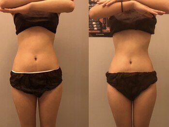 プシュケ(PSYCHE)/20代女性ビフォーアフター