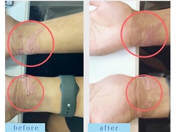 アフロディーテ(APHRODITE)/ビフォーアフター