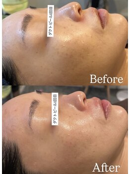 ハレアンド(Hare&)/ダクトピールで美肌と毛穴レス◎