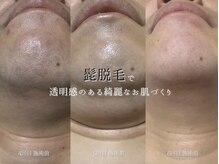 トノ(TONO)/before→after