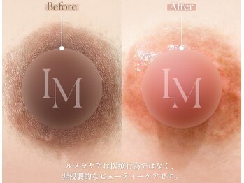 ビューティ サロン ココ ア ドール(Coco a Doll)の写真/【黒ずみ悩みに終止符】納得の結果にリピーター続出！韓国最先端美容ルメラで効果実感◎是非お試し下さい♪