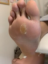 ランカ(RUNKA)/ヒールダコ