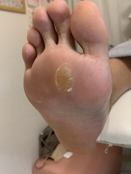 ランカ(RUNKA)/ヒールダコ