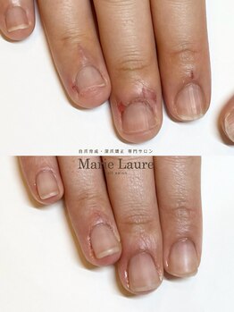 マリーロール 梅田店(Marie Laure)/自爪育成/深爪矯正/ネイルケア