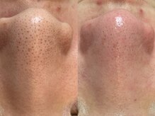 ヴィーヴ 京橋(vive)/【韓国式3D毛穴洗浄】