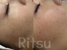 リツ(Ritsu)/シミケア