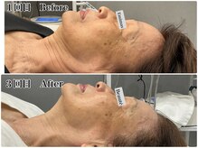 エミマス ボーテ(Emimas Beaute’)/７０代　小顔矯正＆幹細胞３回目