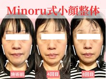 フレキシボディ(FlexiBody)/小顔施術ビフォーアフター #9