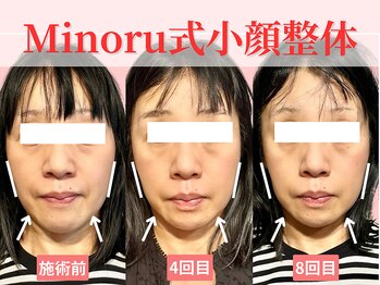 フレキシボディ(FlexiBody)/小顔施術ビフォーアフター #9