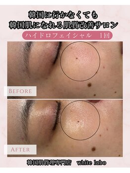 ホワイトラボ 梅田(White labo)/【施術例】ハイドロフェイシャル