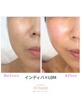リサプリ(Re: Supple)/インディバ×LDMで上向き肌へ